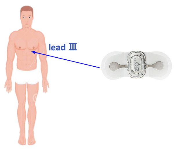 Acute Coronary Syndrome Detection